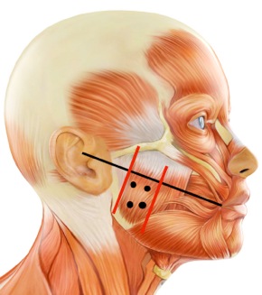 Bruxism Injection Chart