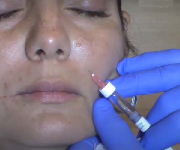 Why a Lip Filler At-Home Kit Is a Bad Idea