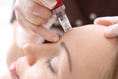 Is Micro Needling Effective?