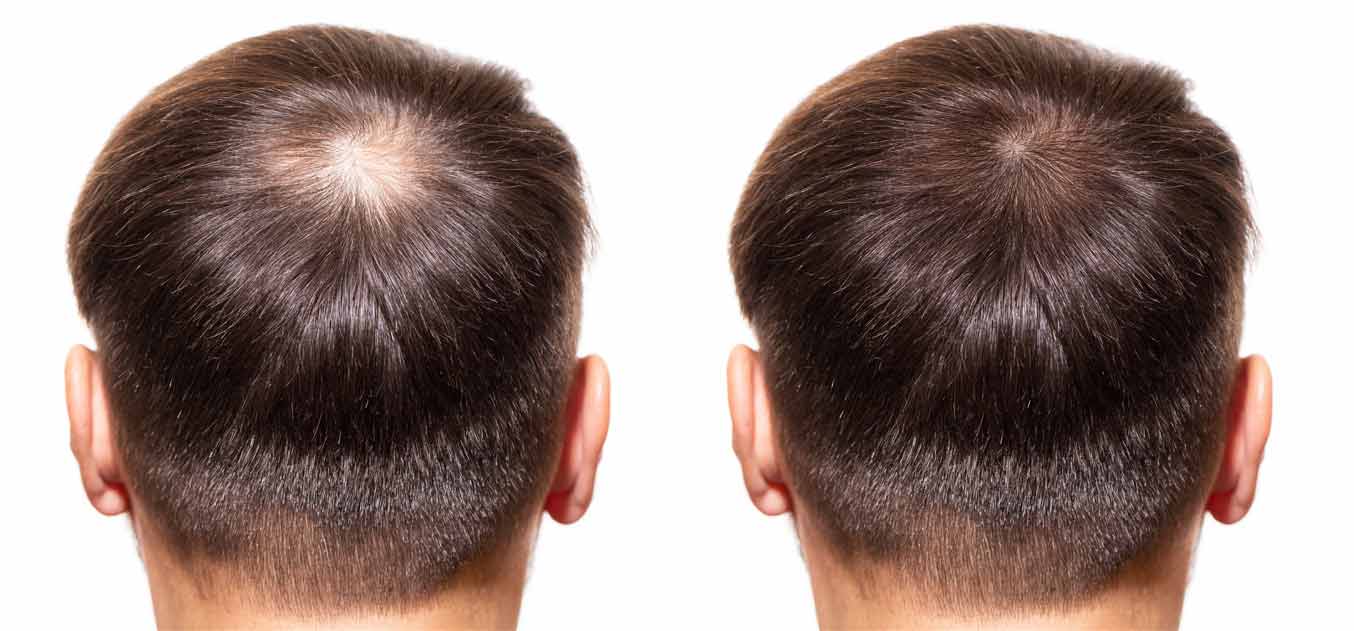 PDOgro for Hair Growth: Non-Surgical Hair Restoration