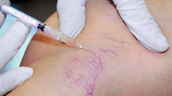 sclerotherapy for physicians & nurses picture