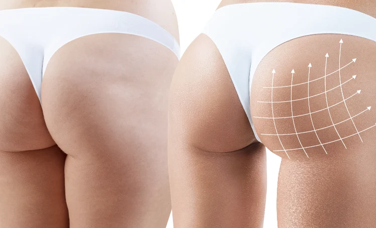 The Perfect Butt: Injectable Services for Buttock Augmentation