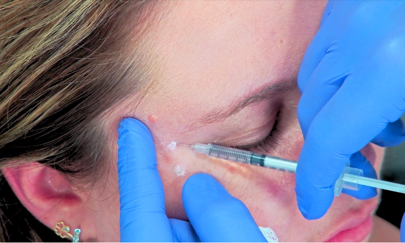 advanced botox and dermal filler training photo gallery 4