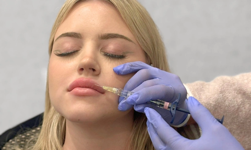 advanced lip filler injection techniques photo gallery 5