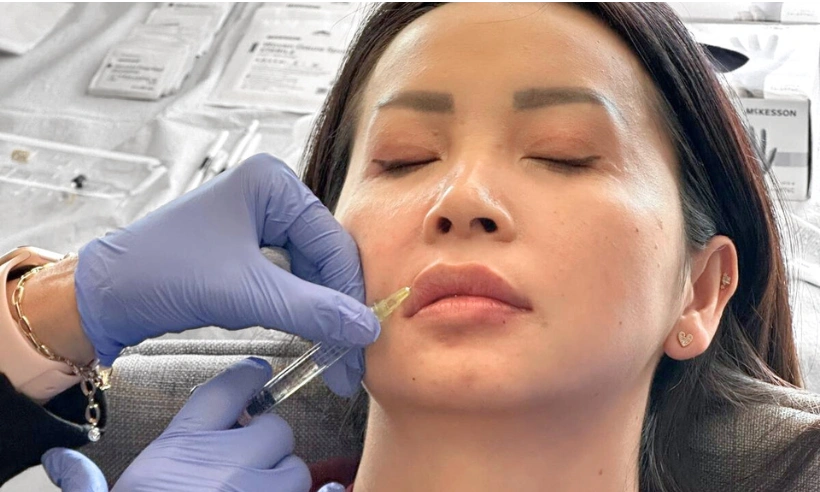 advanced lip filler injection techniques photo gallery 6