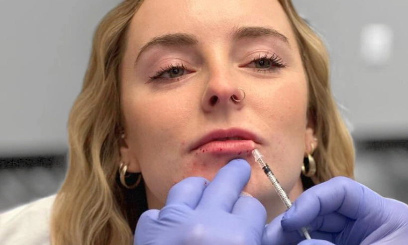 advanced lip filler injection techniques photo gallery 8