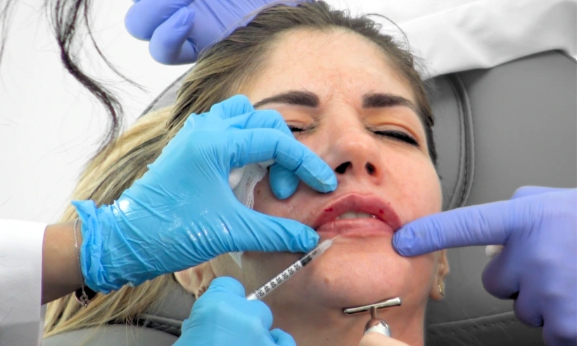 advanced lip filler injection techniques photo gallery 9