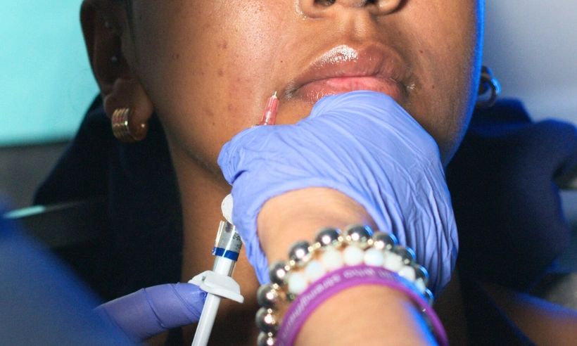 dermal filler training photo gallery 6